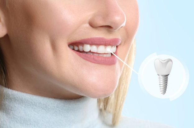 Comprehensive Dental Implants Guide